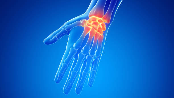 Síntomas de la artrosis de muñeca